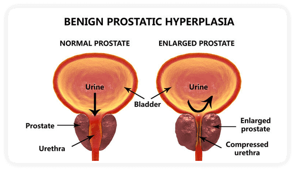 ProstaClear All-Natural Prostate lowers prostate swelling, inflammation, enlargement, estrogenic aromatase, Urgency, Frequency, Nocturia, improves urinary flow