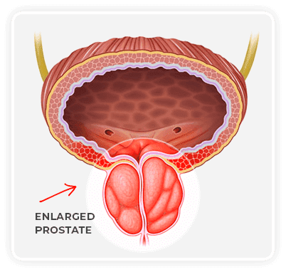 ProstaClear All-Natural Prostate lowers prostate swelling, inflammation, enlargement, estrogenic aromatase, Urgency, Frequency, Nocturia, improves urinary flow